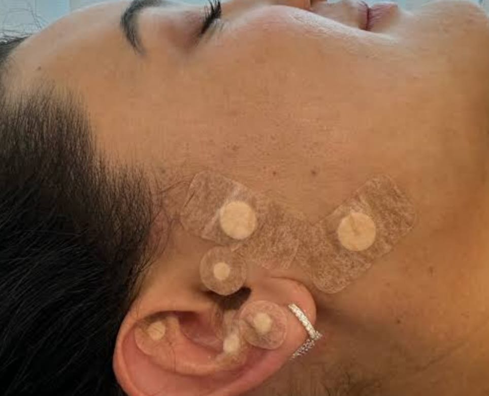 Auriculoterapia em adultos