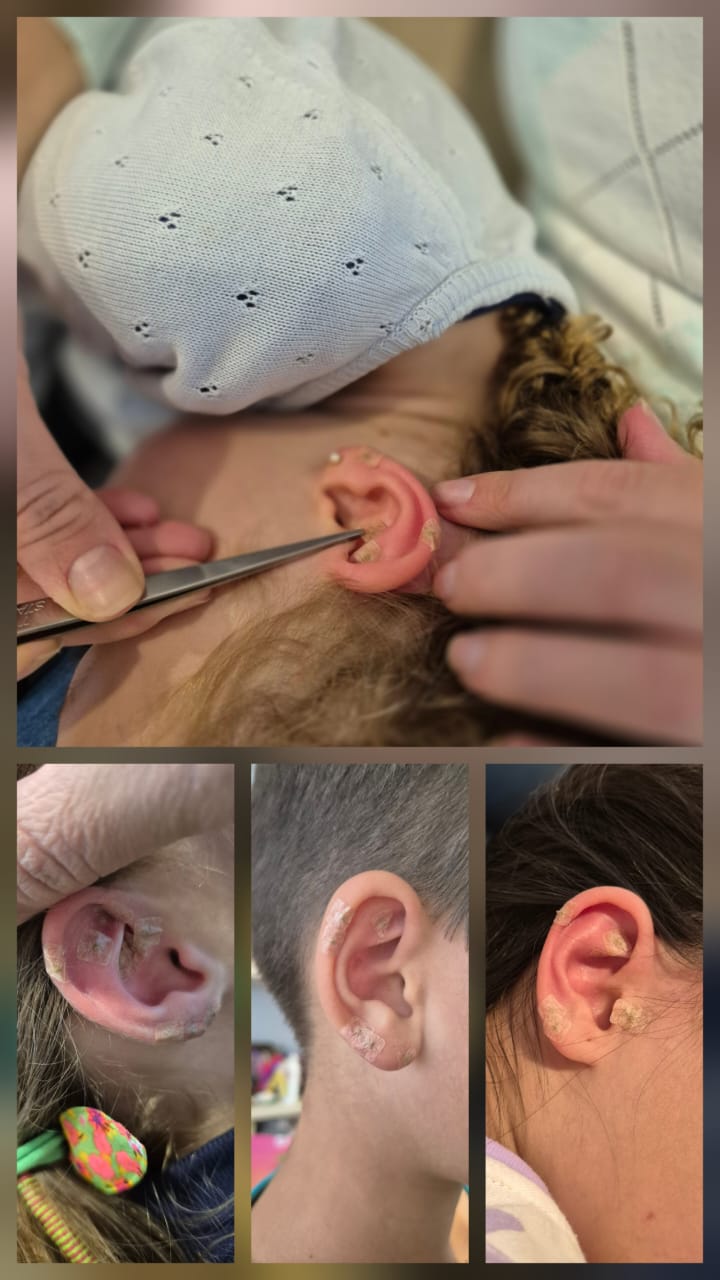 Auriculoterapia em crianças