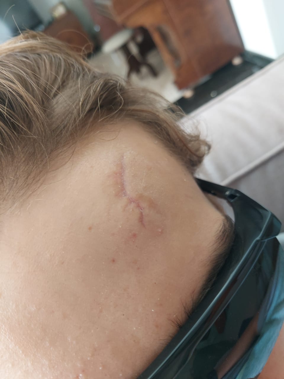 Laser para cicatrizes