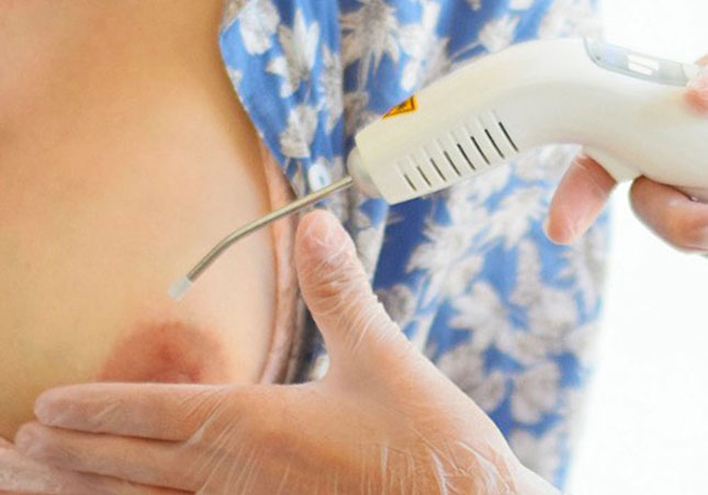Laser para fissuras mamilares